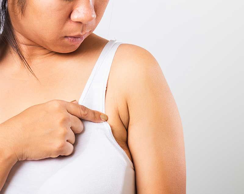 Understanding Arm Pit Lipo: A Comprehensive Guide