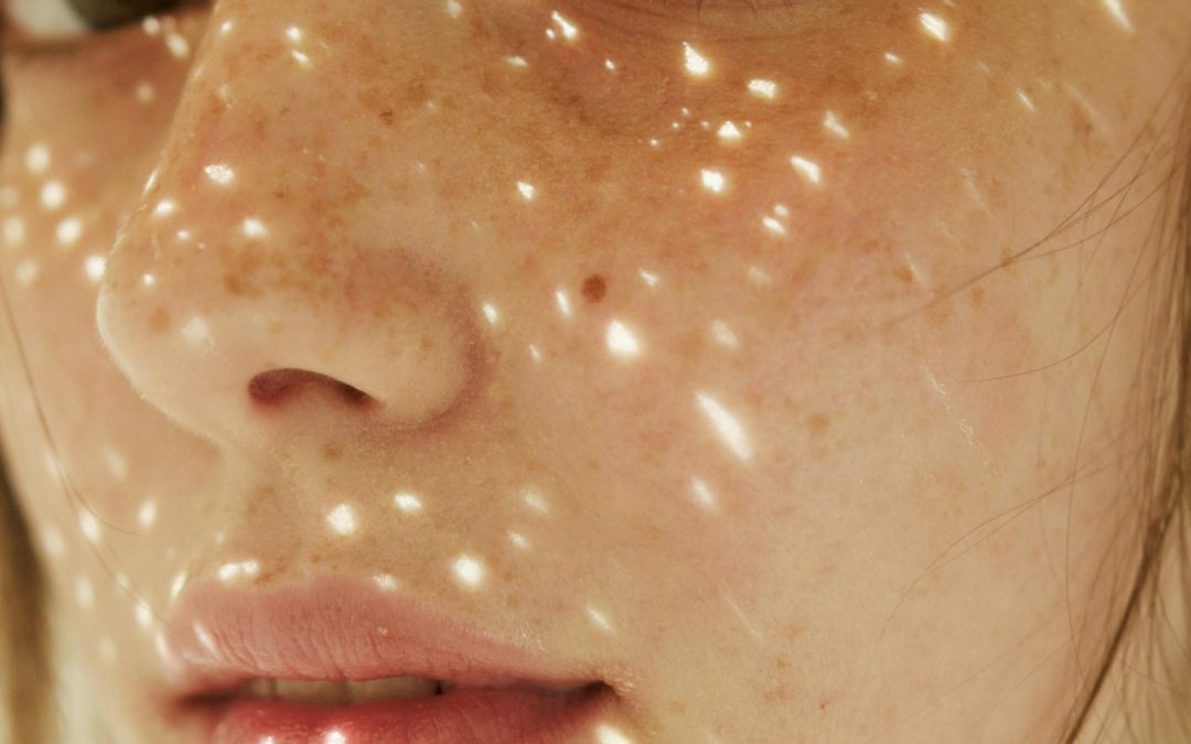 Todo Sobre Celulitis y Estrías: Información y Consejos