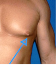 Gynäkomastie - eine vergrösserte Brustdrüse ohne Fettgewebe