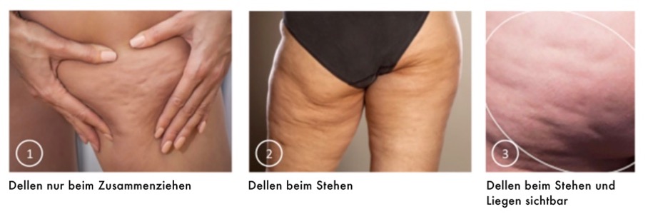 Cellulite, was tun dagegen?