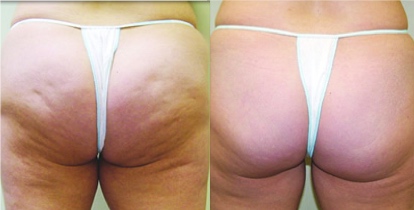 Cellulite behandeln mit Carboxytherapie