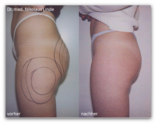 po cellulite behandlung.jpg