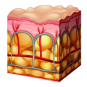 Cellulite bei Frauen: Struktur der dünnen Oberhaut 