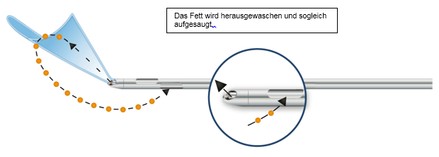 Wasserstrahl Fettabsaugung