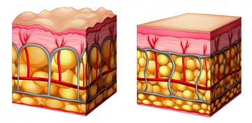 Cellulite behandeln Endermologie