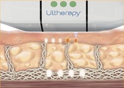 Hochintensiver fokussierter Ultraschall mit grossem Straffungseffekt - die Ultherapy® Behandlung