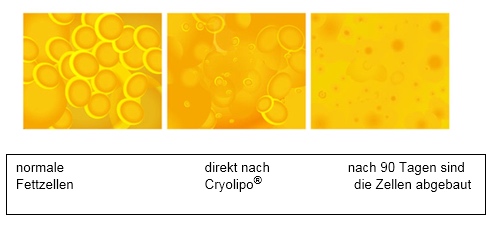 Abbau des Fettgewebes: das abgebaute Fettgewebe bildet sich nicht wieder nach