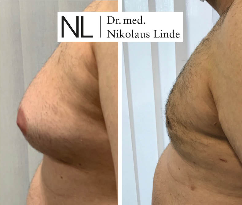 Männerbrust vorher/nachher Gynäkomastie entfernen LIPOCLINIC