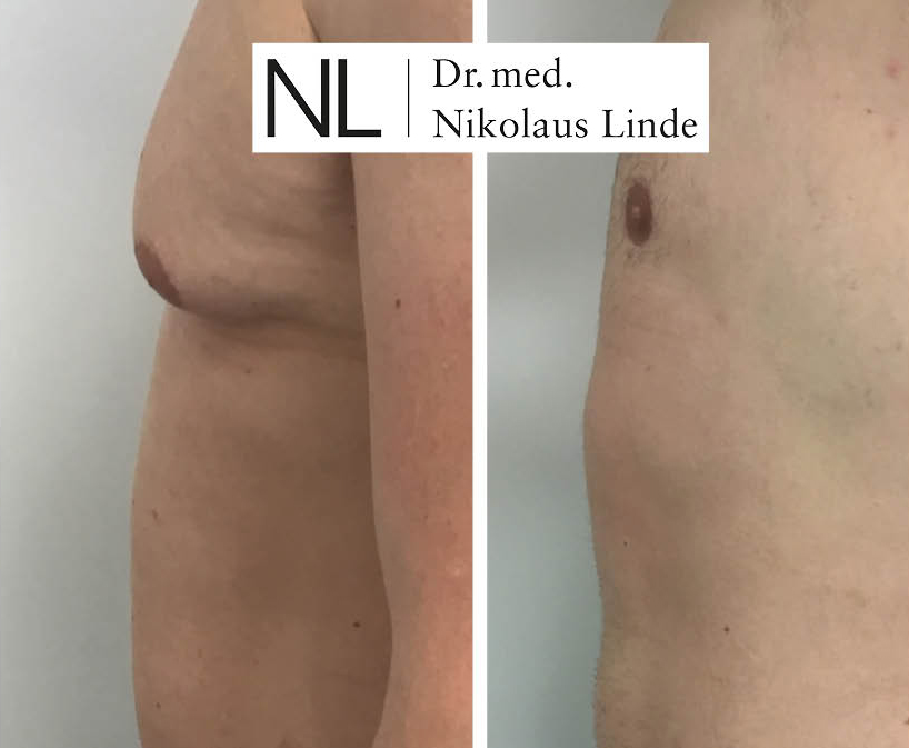 Männerbrust vorher/nachher Gynäkomastie entfernen LIPOCLINIC