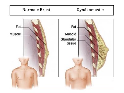 Normale Brust versus Gynäkomastie - vergrösserte Brust beim Mann