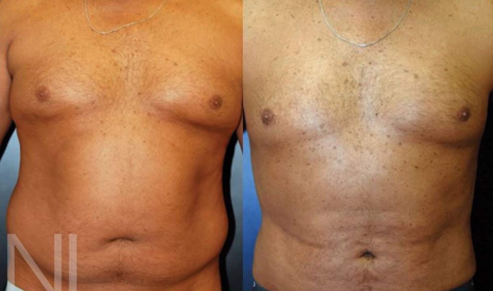 Fettabsaugung beim Mann: Vorher-/Nachher-Bilder nach der Liposuktion am Bauch, an der Taille und an den Hüften