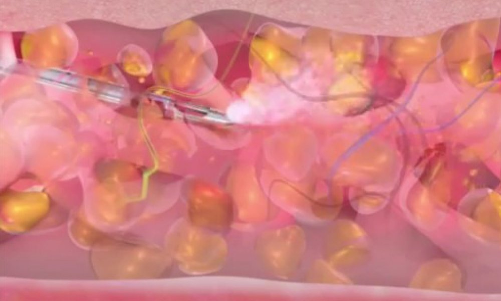 Dr. Lindes Wasserstrahl Fettabsaugung (WAL) bodyjet® Fettabsaugung