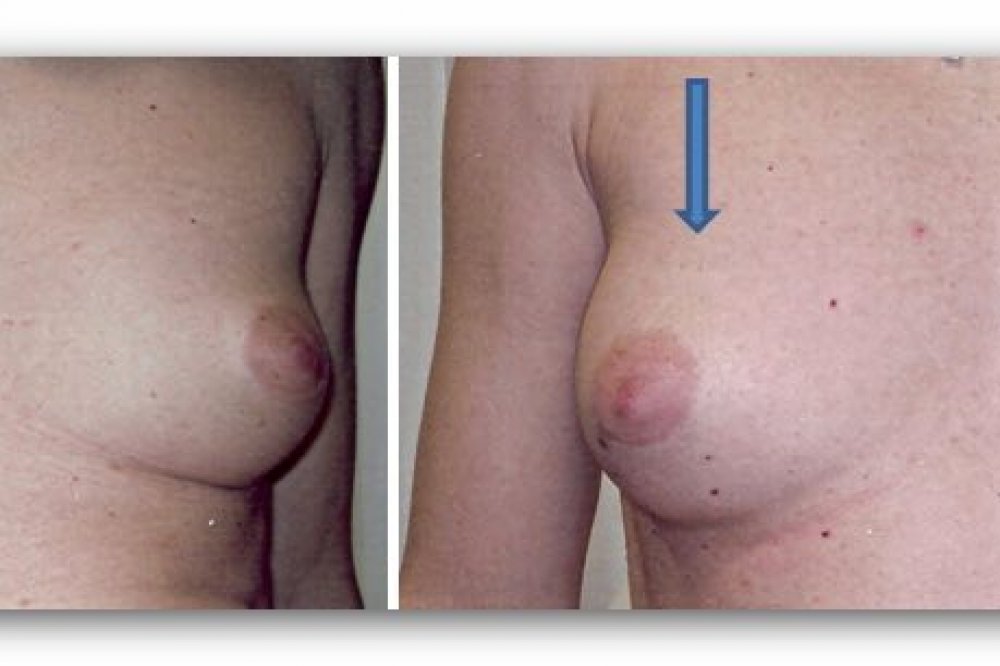 Eigenfett in die Brust: Vorher-/Nachher-Bilder 