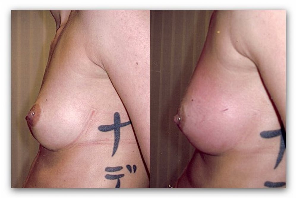 Brustvergrösserung mit Eigenfett bei einer Frau: Vorher-/Nachher-Bilder 