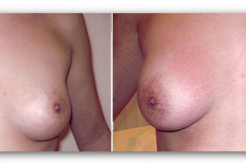 Vorher-/Nachher-Bilder nach der Brustvergrösserung mit Eigenfett