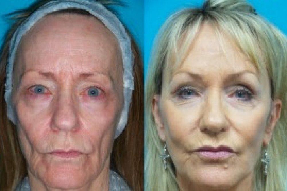 Unterspritzung mit Eigenfett im Gesicht: Vorher-/Nachher-Bilder