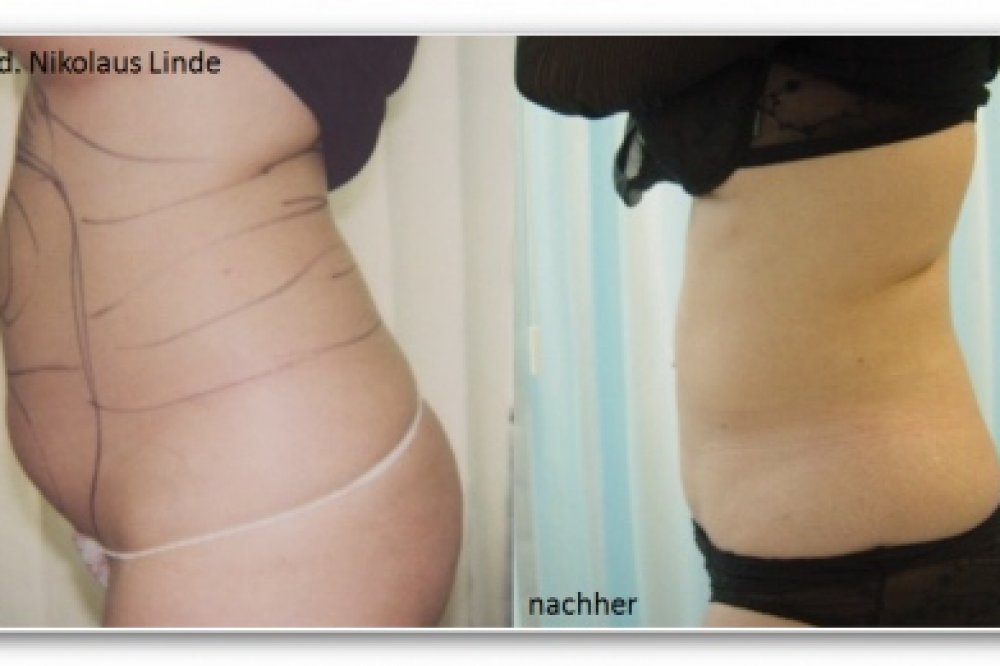 Massive Liposuktion am Bauch: Vorher-/Nachher-Bilder