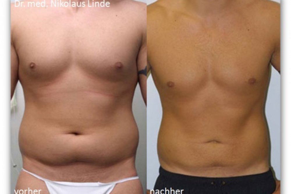 Sixpack-Modellierung – Absaugen der Fettpolster am Bauch: Vorher-/Nachher-Bilder 