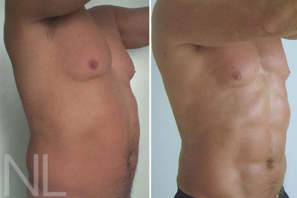 High Definition Fettabsaugung am Bauch beim Mann: Sixpack-Modellierung