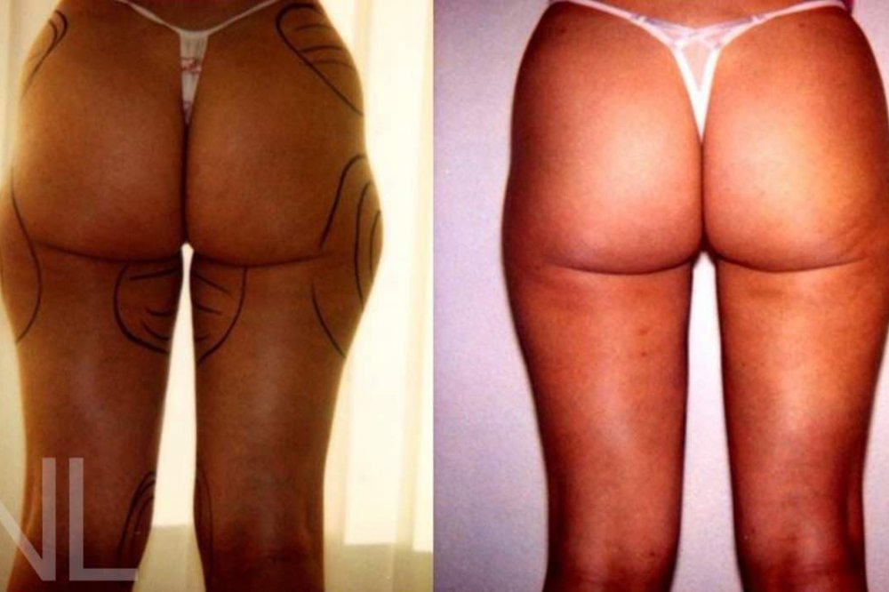 Vorher-/Nachher-Bilder nach der Fettabsaugung an den Hüften und an den Oberschenkelinnenseiten und -aussenseiten