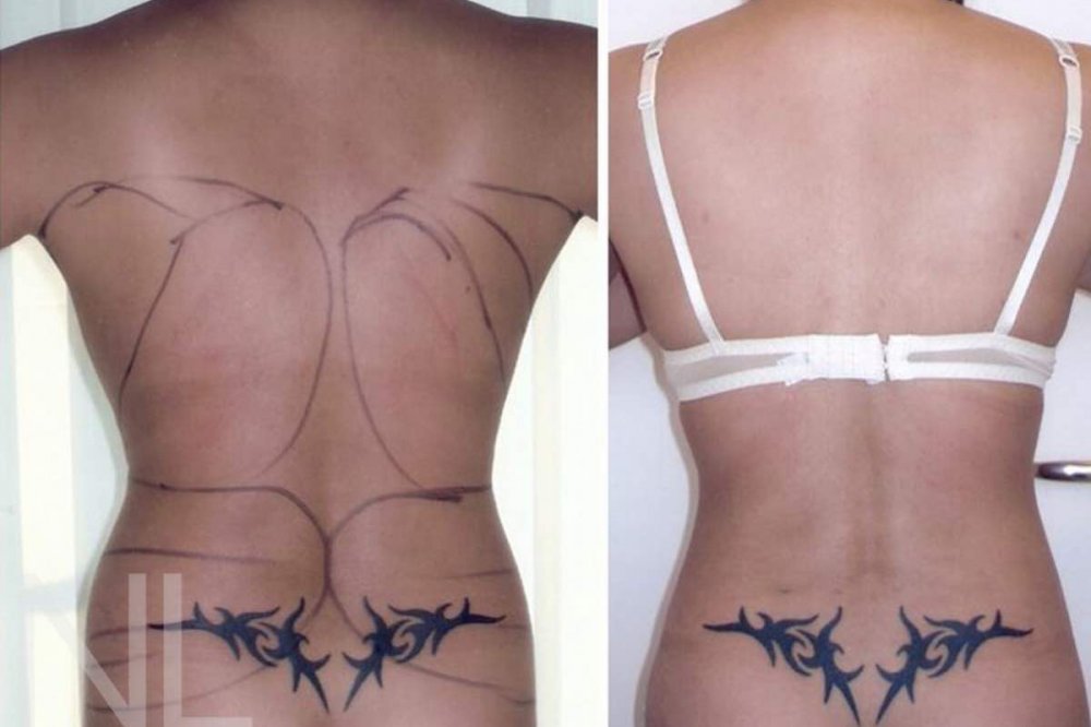 Vorher-/Nachher-Bilder nach der Fettabsaugung am Rücken und an den Hüften