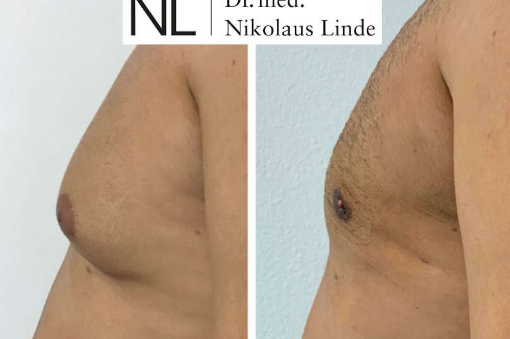 Männerbrust vorher/nachher Gynäkomastie entfernen LIPOCLINIC