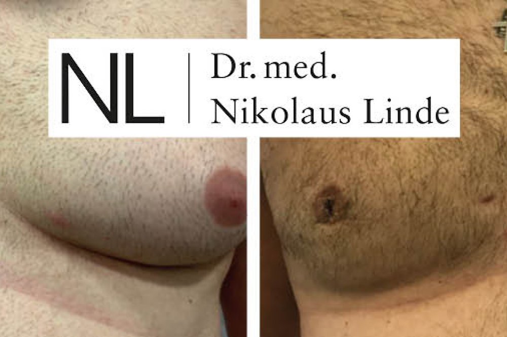 Männerbrust vorher/nachher Gynäkomastie entfernen LIPOCLINIC