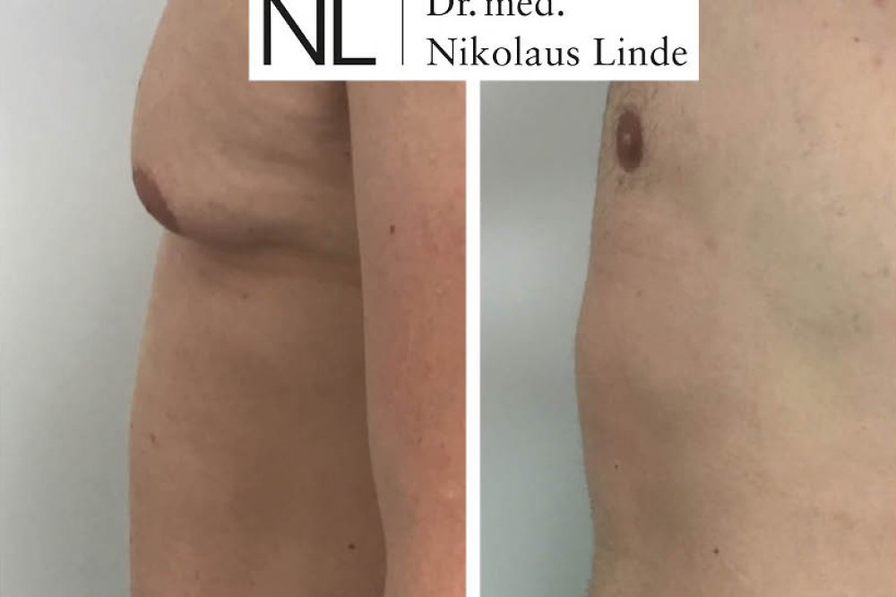 Männerbrust vorher/nachher Gynäkomastie entfernen LIPOCLINIC
