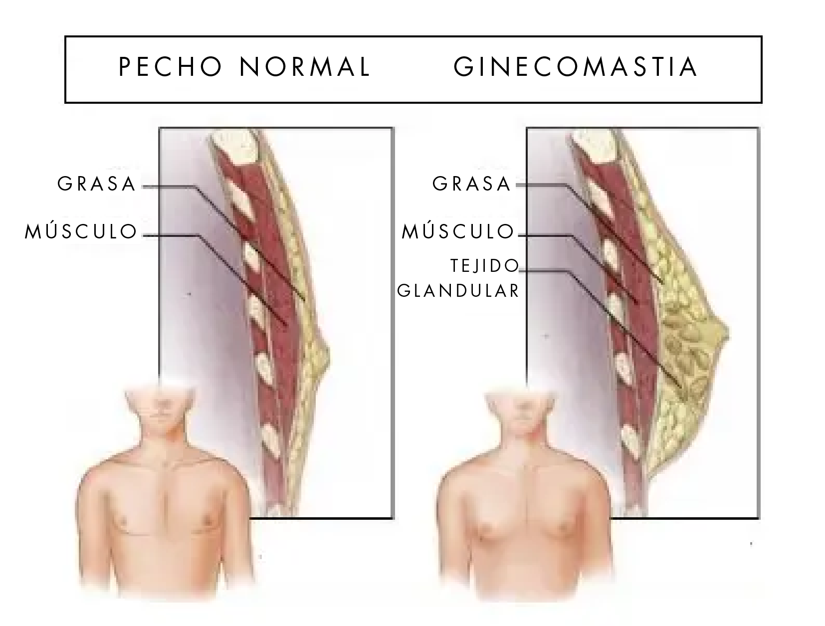 GINECOMASTIA