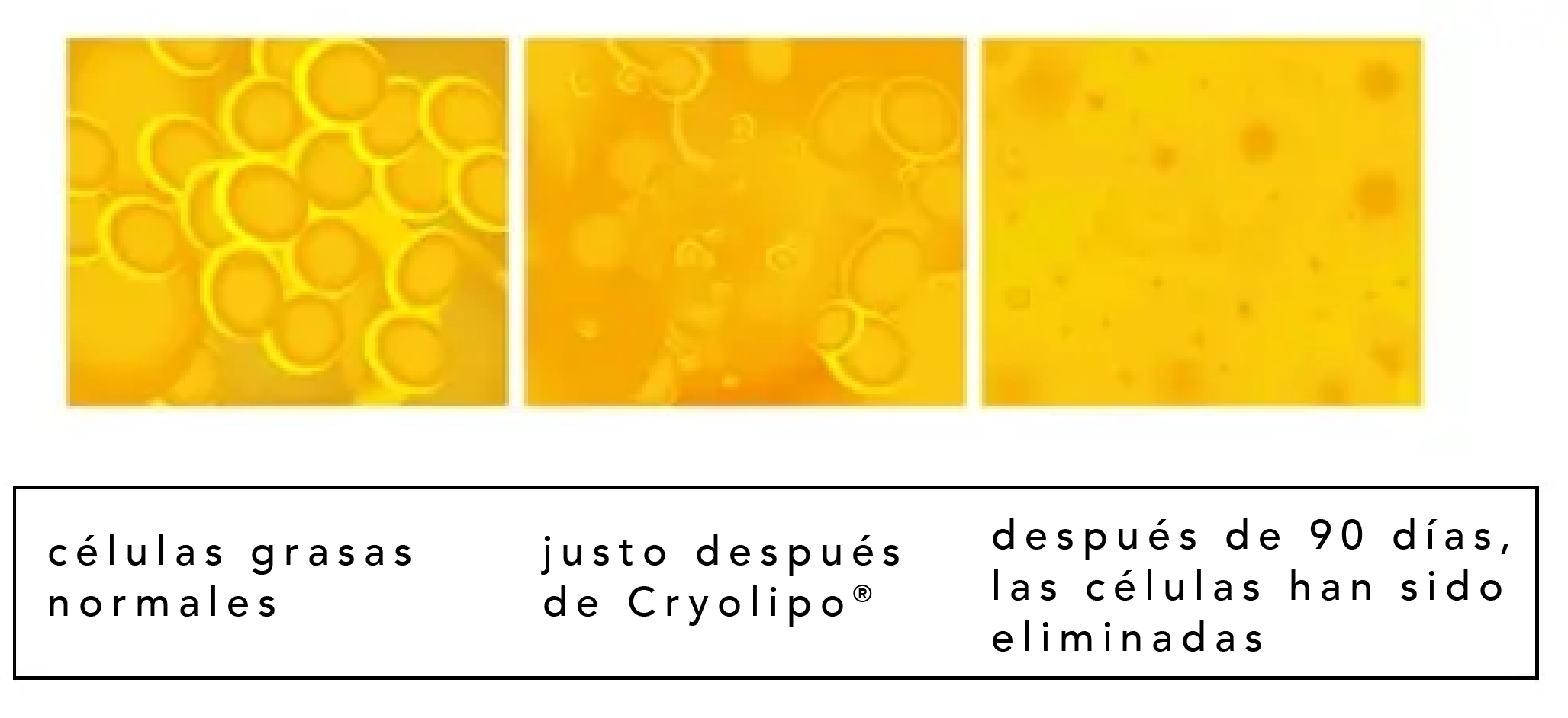 criolipolisis 90 dias