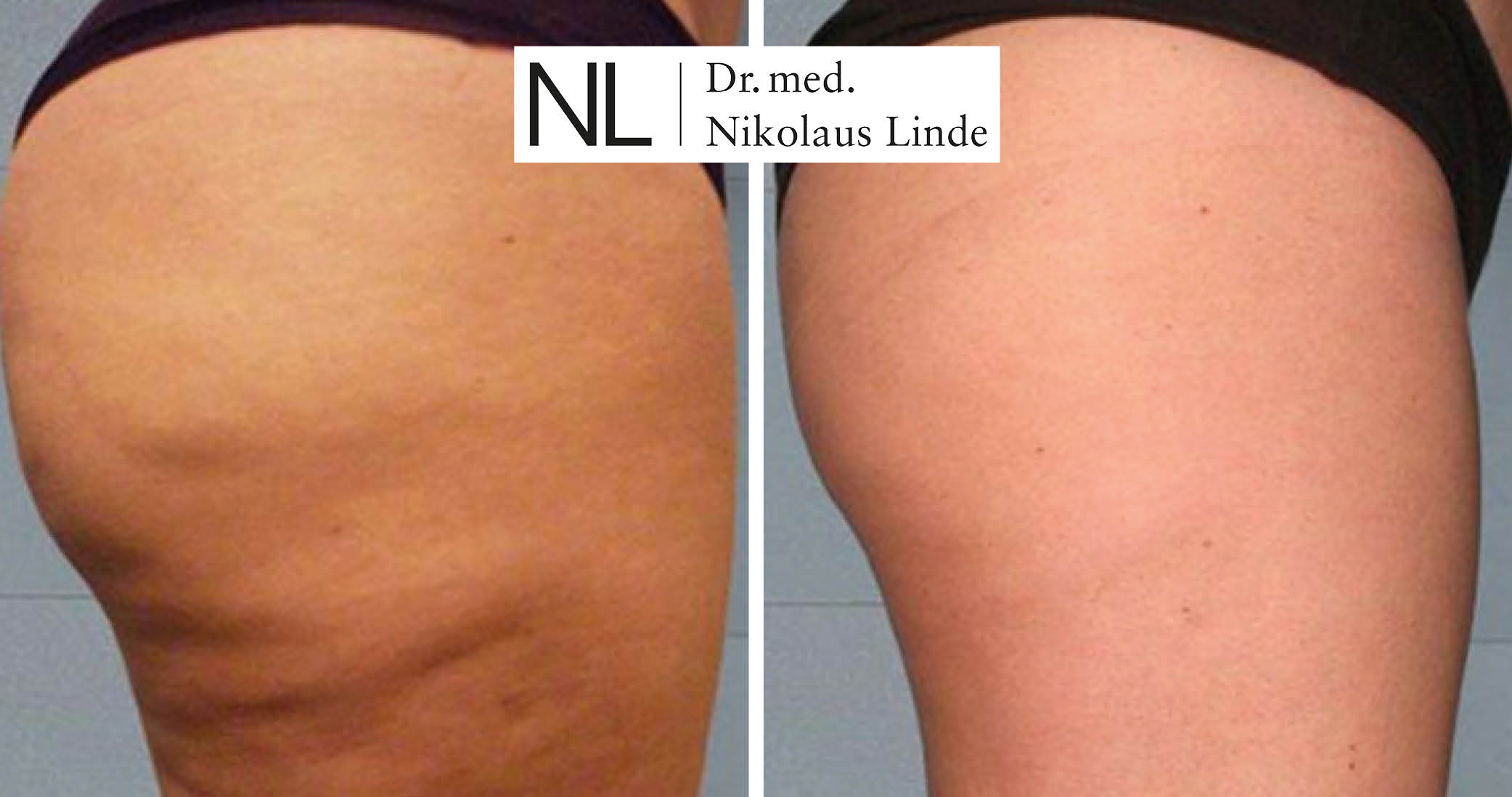 Cellulite Behandlung Ergebnis