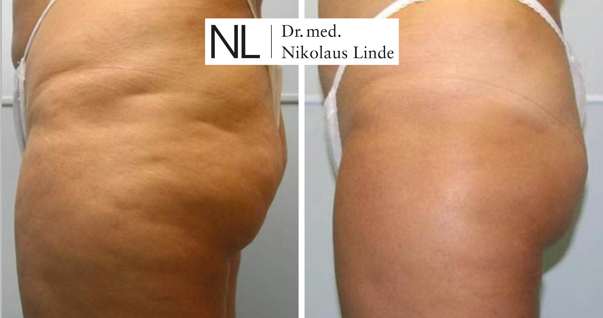Cellulite Behandlung Vorher Nachher