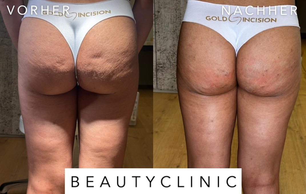 Cellulite Vorher Nachher Goldincision