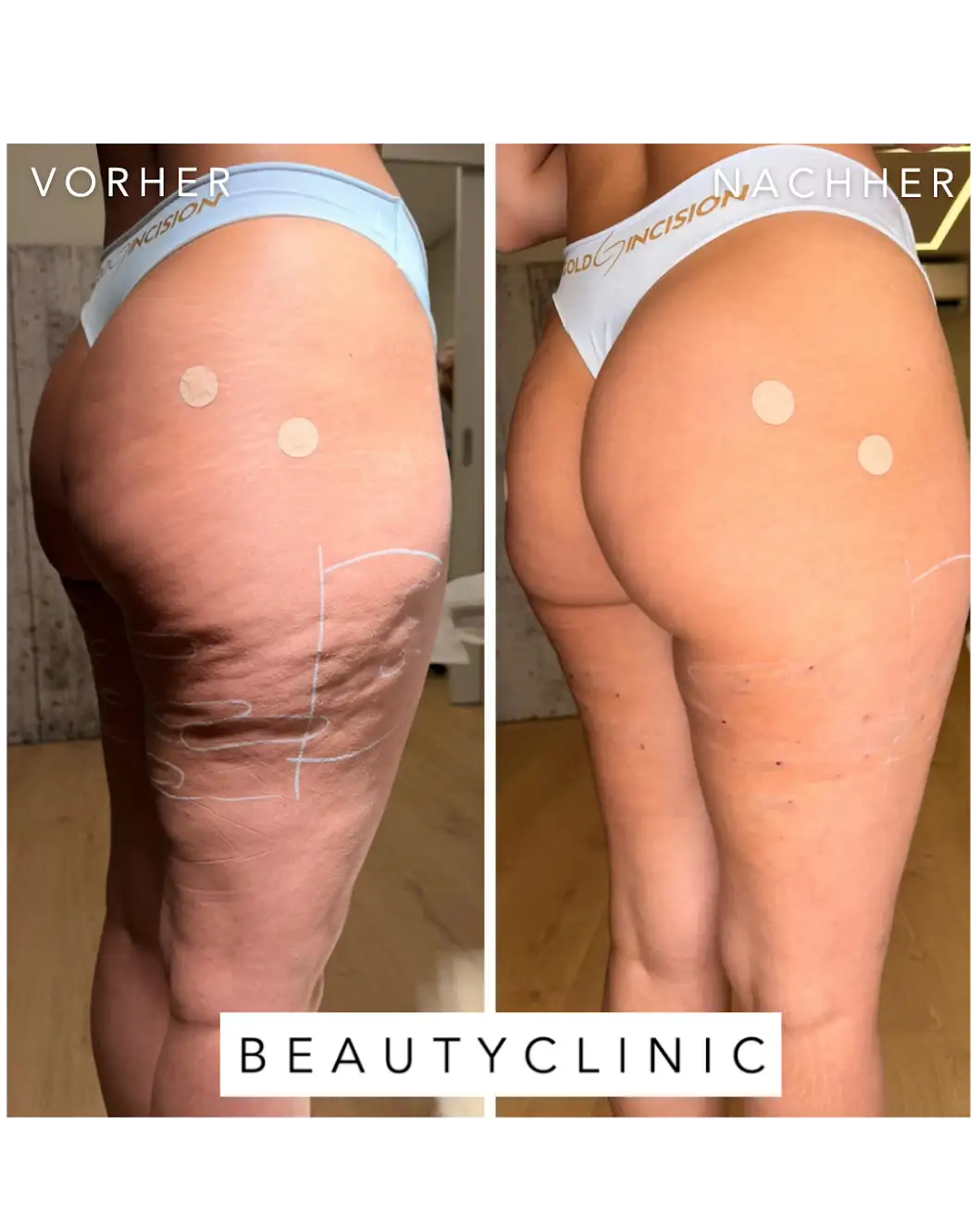 Cellulite Behandlung mit Goldincision