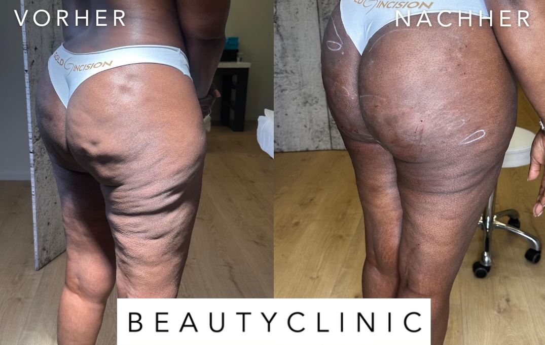 Goldincision Cellulite Vorher Nachher