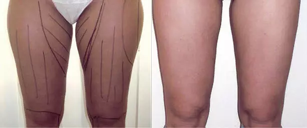 Fettabsaugung Bein