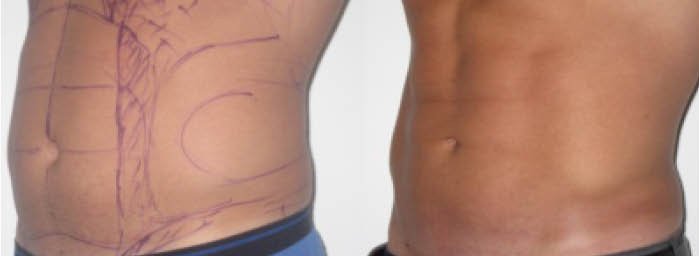 Fettabsaugung Sixpack High-Definition