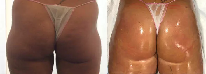 Fettabsaugung Hip Dips