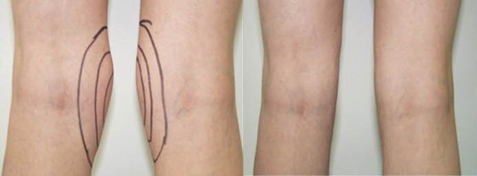 Fettabsaugung Knie