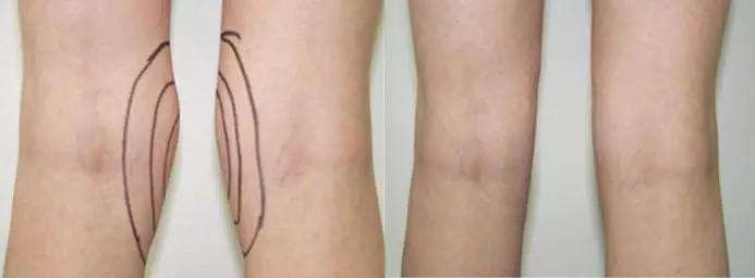 Fettabsaugung Knie