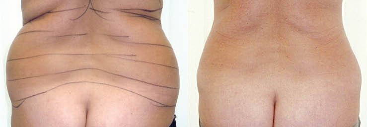 Fettabsaugung Rücken Love Handles