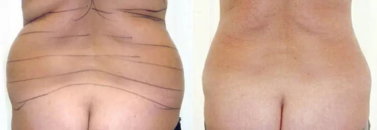 Fettabsaugung Rücken Love Handles
