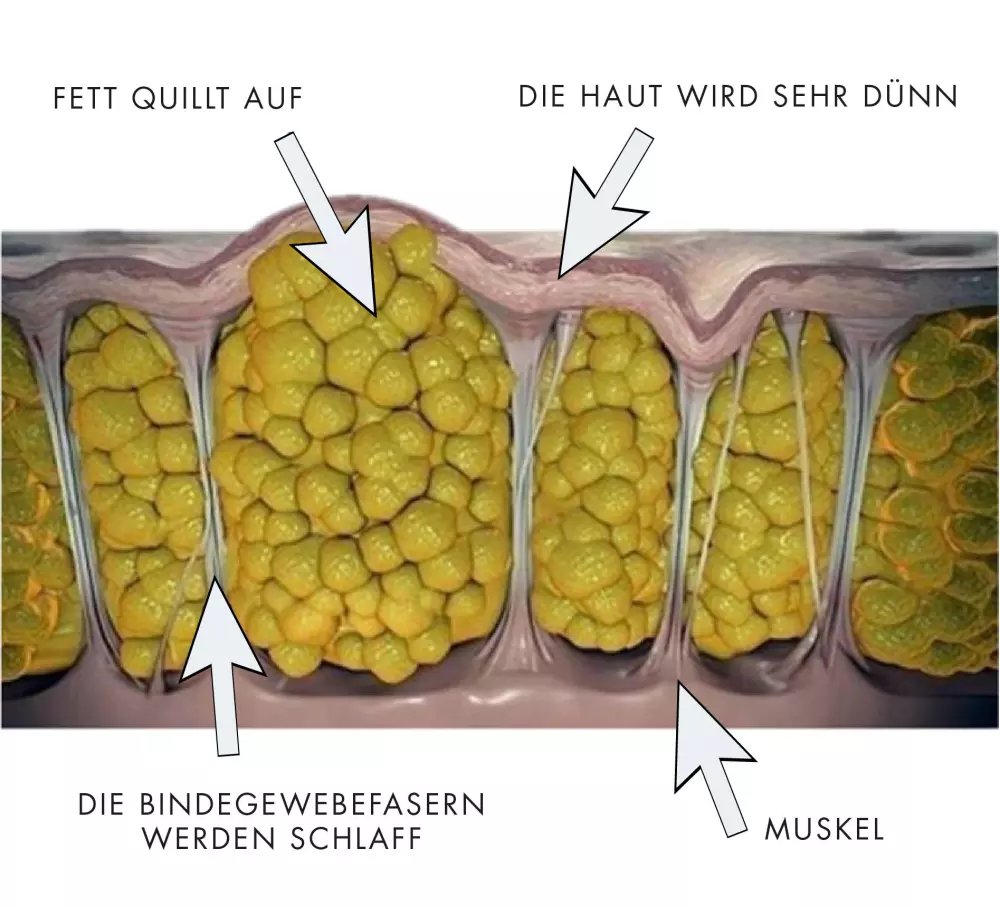 Cellulite Entfernung