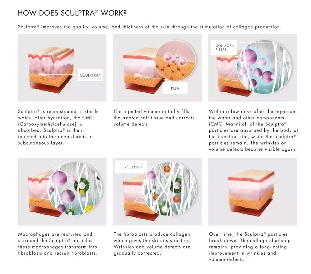 How does Sculptra work?