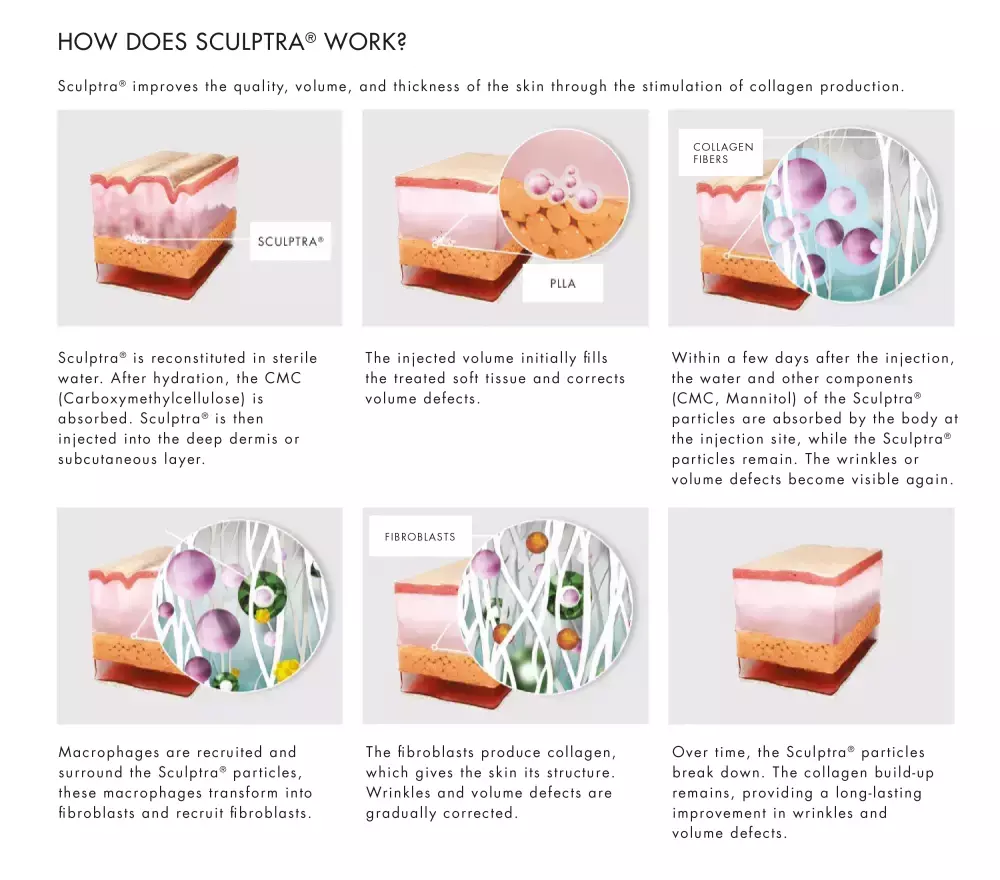 How does Sculptra work?