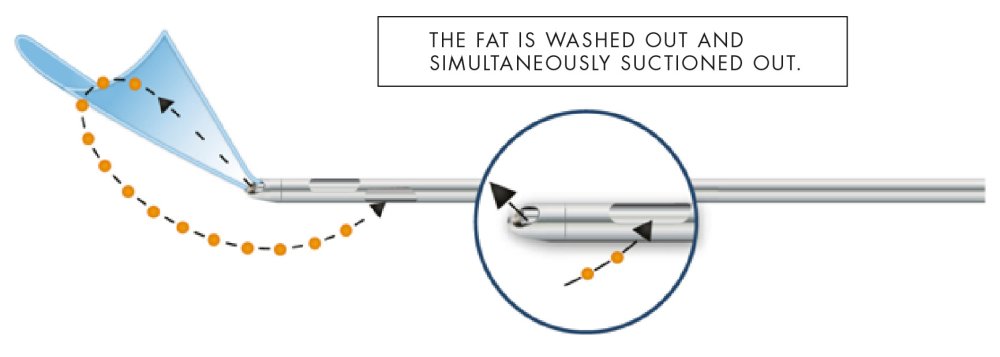 Autologous fat transfer in Switzerland