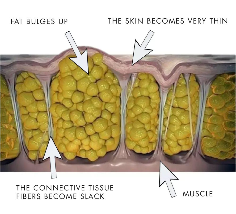 Cellulite Treatment Switzerland