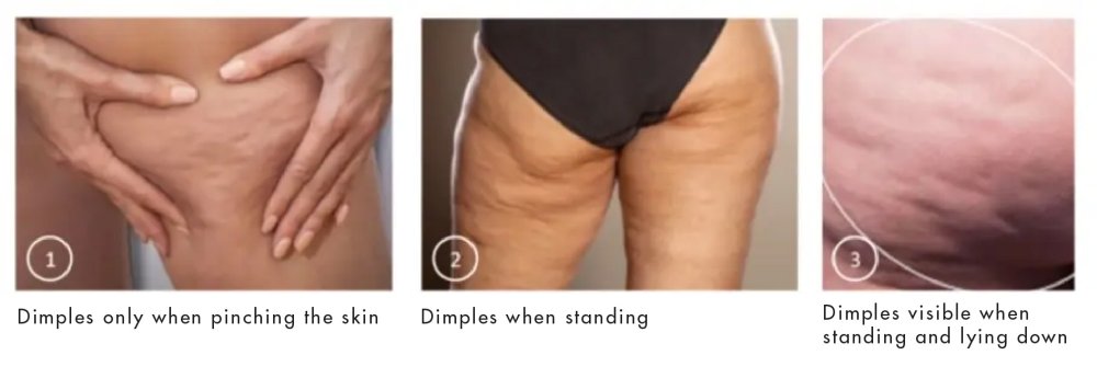 Cellulite Types
