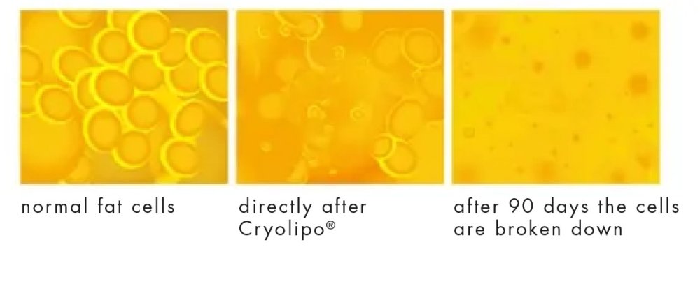 When are cryo results visible