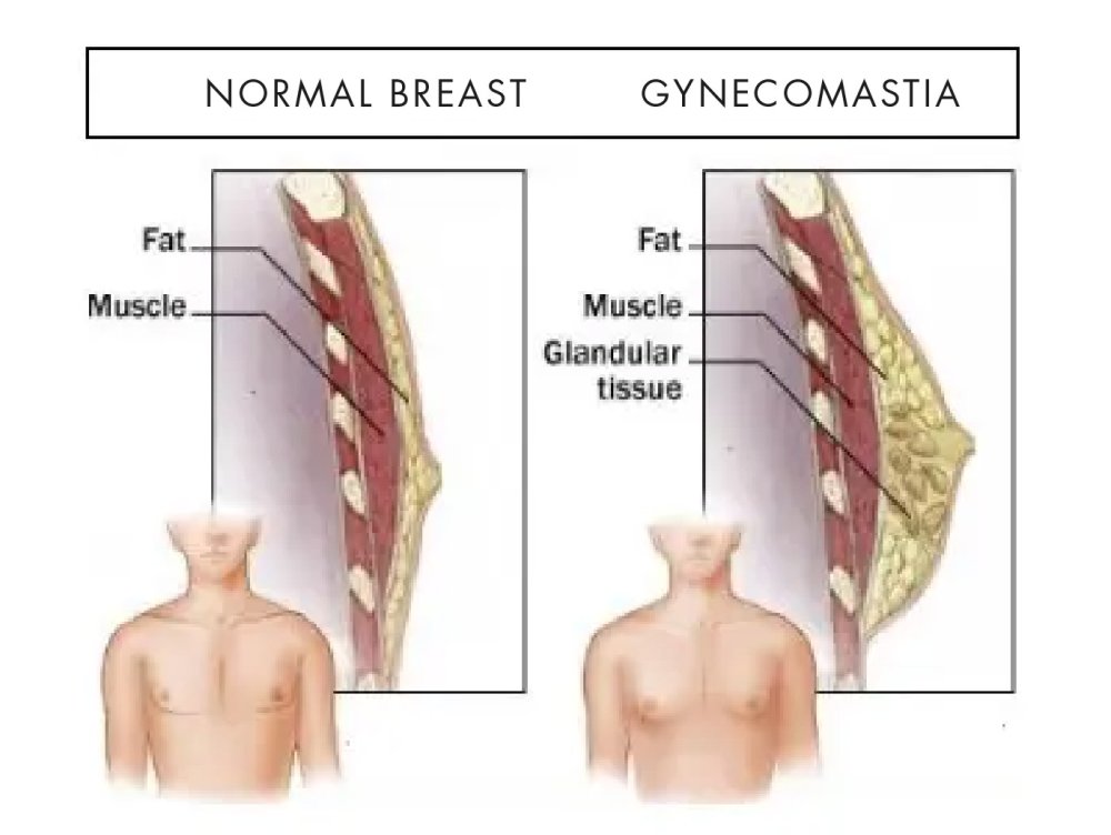 Gynecomastia surgery in Switzerland